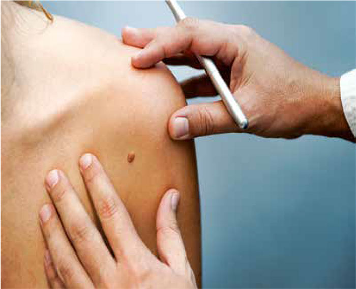 A closeup of skin with a mark on it being examined by a doctor